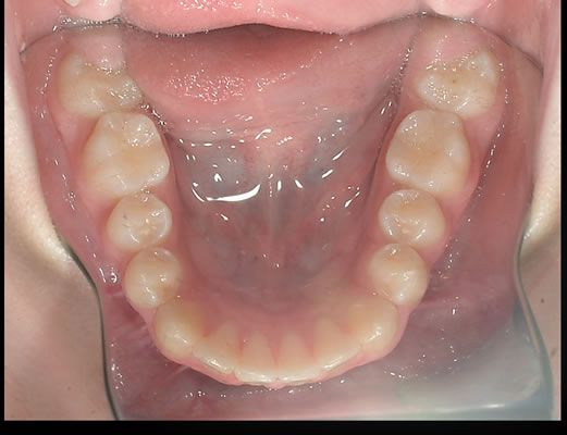 Orthodontic Patient San Diego